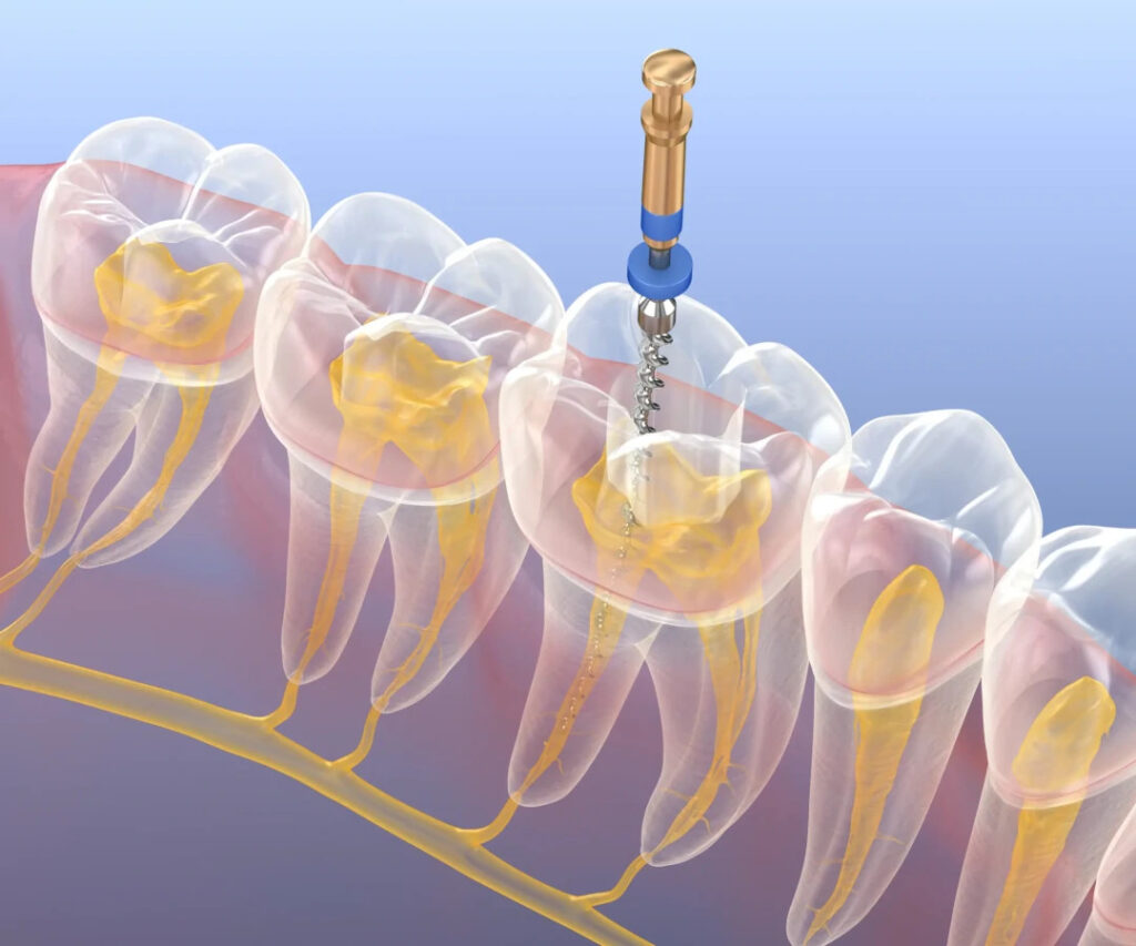Wurzelkanalbehandlung (Endodontie)